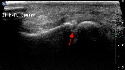 pannicolo fibrotico intrarticolare