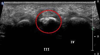 erosione terza testa metatarsale