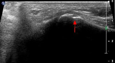 erosione ossea della quinta testa metatarsale 01