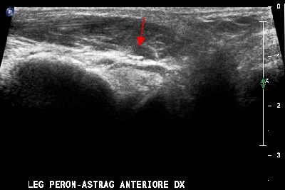 Lesione legamento peroneo-astragalico anteriore