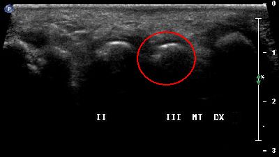 Modifiche anatomiche testa metatarsale 02