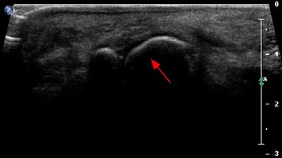 Modifiche anatomiche testa metatarsale 03