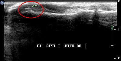 microavulsione falange distale primo dito 01