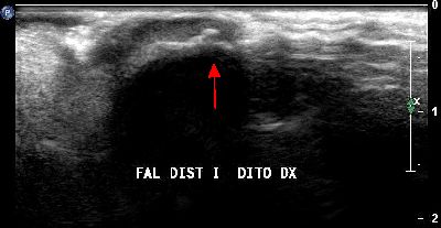 microavulsione falange distale primo dito 02