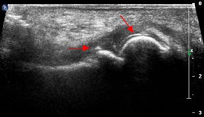 Calcificazione capsula articolare