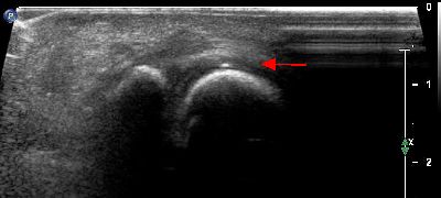 Calcificazione intra tendinea 01