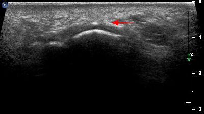 Calcificazione intra tendinea 02