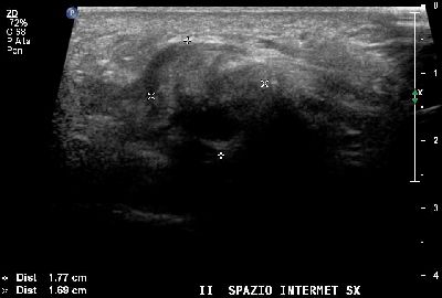 Neuroma Hauser ripresa longitudinale