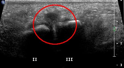 Neuroma Hauser ripresa longitudinale