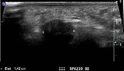 Neuroma Morton 01