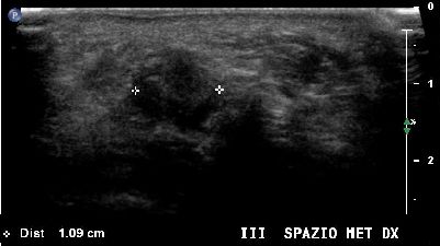 Neuroma Morton 02