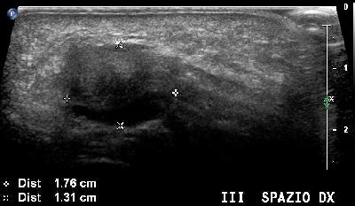 Neuroma Morton  ripresa longitudinale