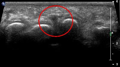 Neuroma Morton  ripresa trasversale