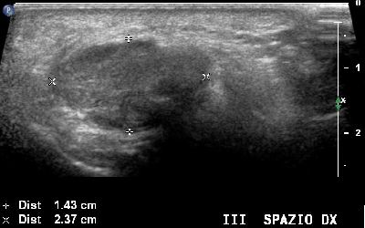 Neuroma Morton  ripresa longitudinale