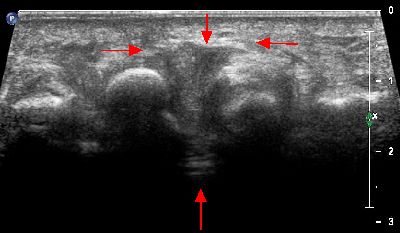 Neuroma Morton  ripresa trasversale