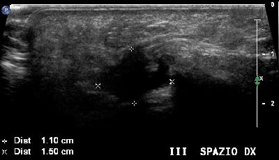 Neuroma Morton